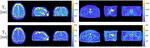 Low-rank inversion reconstruction for through-plane accelerated radial MR fingerprinting applied to relaxometry at 0.35 T